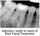 Tooth Before Root Canal Treatment