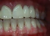 Gap Closed With Dental Bridge