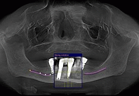 CT Scan Before Treatment