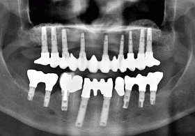 Treatment Completed - X-ray