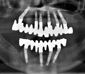 Bone grafting