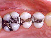 Amalgam Filling