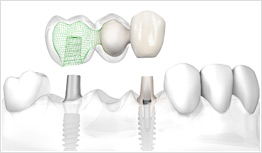 Zirconium All Ceramic Bridge